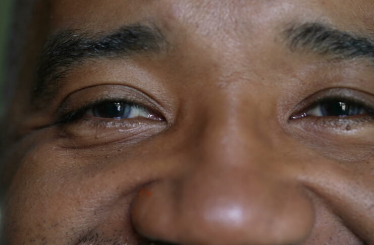 Under Eye Circles Signal Liver